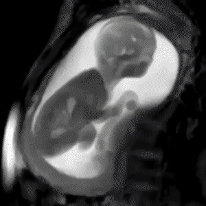 MRI of a baby moving during gestation