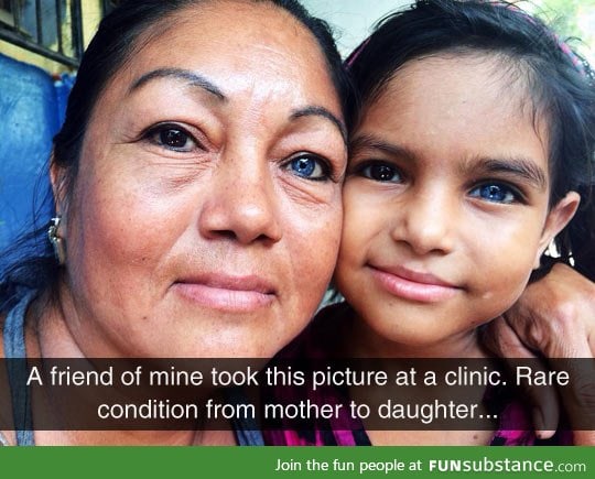 Mother and daughter with heterochromia