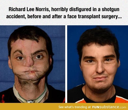 This surgeon did a fantastic job