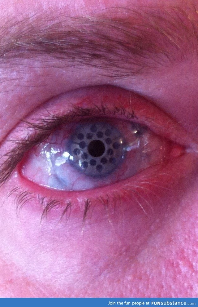A healed after corneal transplant surgery