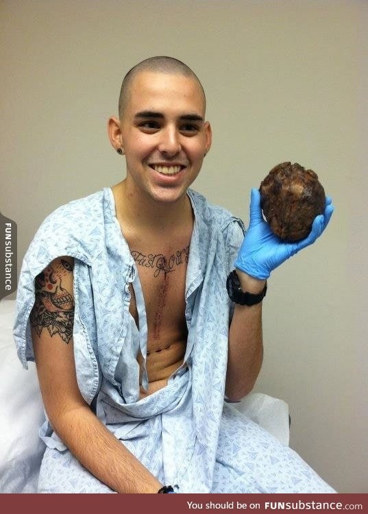 Man holds his own old diseased heart after transplant