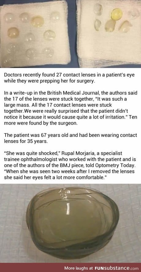 Doctors found 27 contact lenses in a woman's eye, who was scheduled for a surgery