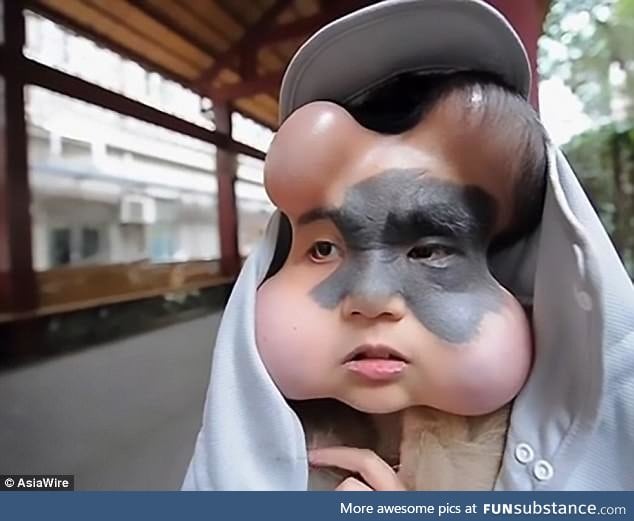 Woman has balloons implanted in her face to expand the skin around a dangerous birthmark