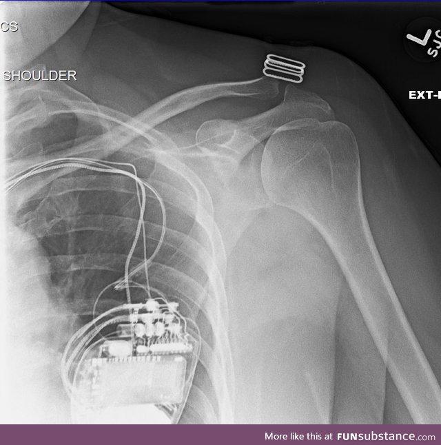 X-ray of shoulder that shows pacemaker