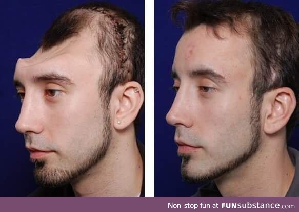 Amazing before and after of a skull reconstruction