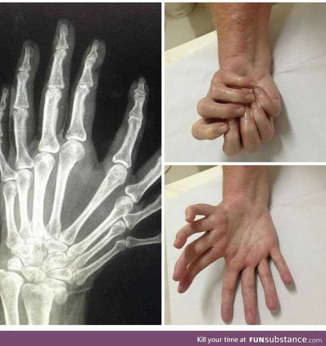 Mirror hand syndrome