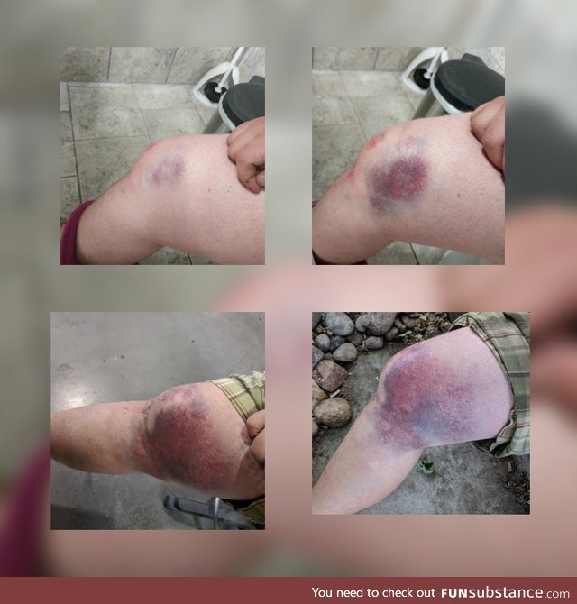 Slow pitch softball knee injury, over 36 hours