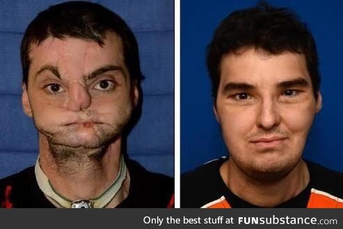 Richard Lee Norris, horribly disfigured in a shotgun accident, before and after surgery