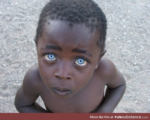Boy with ocular albinism