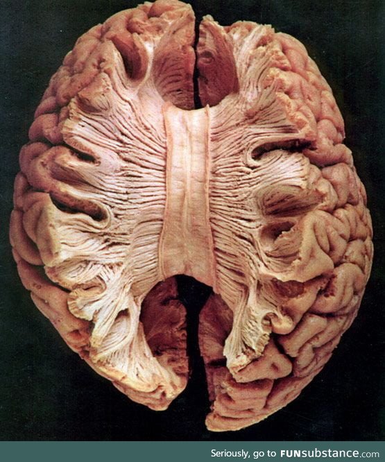 Corpus callosum- the large band of neural fibers connecting the two brain hemispheres