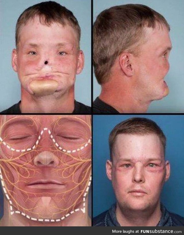 Incredible well performed face transplant