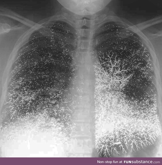X-ray of a patient who attempted suicide by injecting themselves with mercury