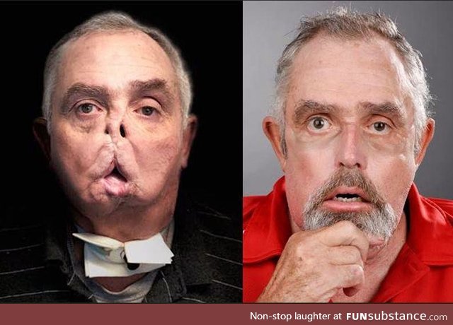 Amazing Face Transplant of Man 7 Years After Tragic Accident