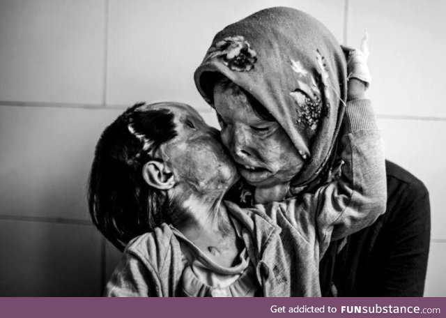 An Iranian woman & her 3 yr old daughter, disfigured from an acid attack from her husband