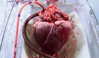 A beating heart awaiting transplant