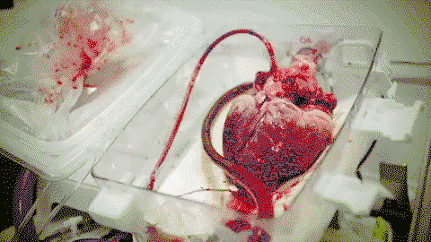 Heart in a transport box for a transplant