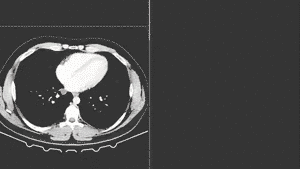 CT scan loop