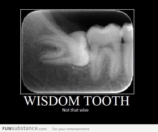 My wisdom tooth