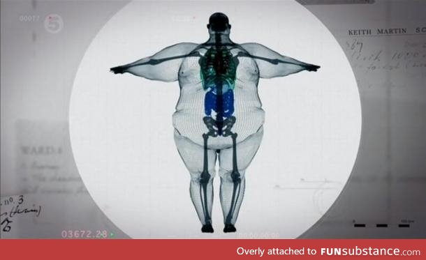 X-ray of a 900 pound man