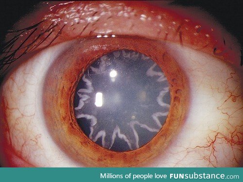 Eye of a 14,000 volt electrocution survivor