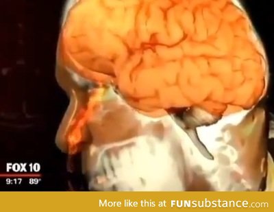 He thought he had a runny nose for 18 months. He was leaking brain fluid