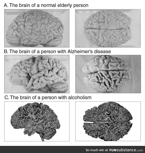 This is what happens to your brain if you have Alzheimer's or a Drinking Problem...