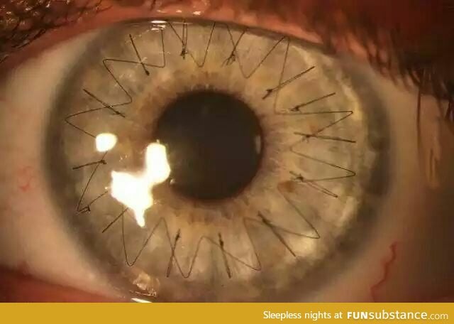Have you ever wondered what stitches on the eye looked like?