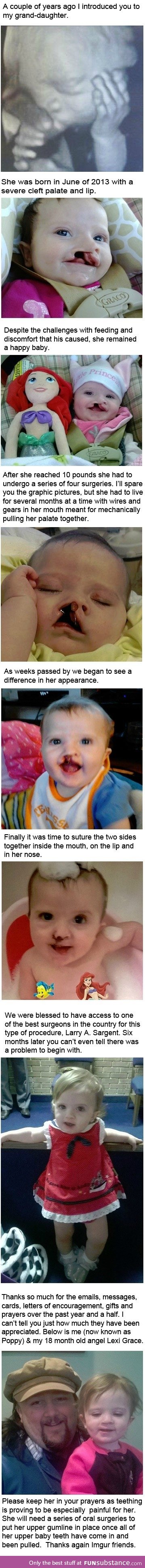 A story of a little girls severe cleft palate and lip