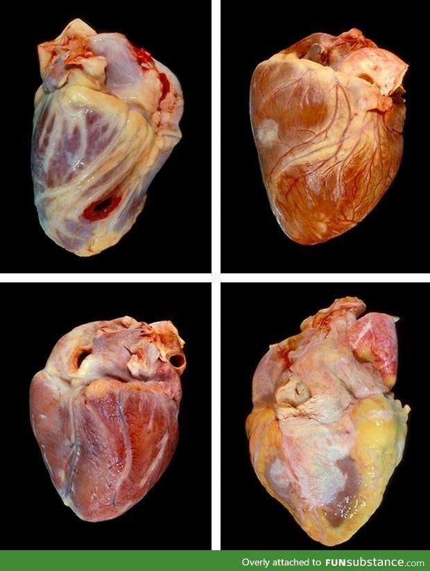 1. Shot in the Heart 2. Cancer Heart 3. Teen Drug Overdose Heart 4. Fatty Oversized Heart