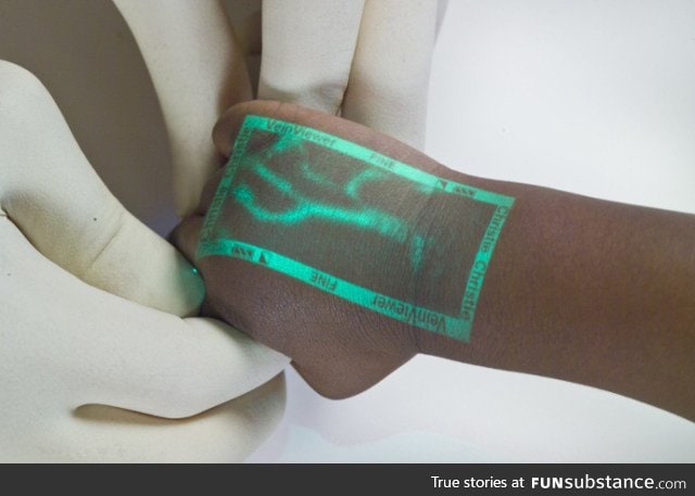 VeinViewer, an infared device that detects the location of a patient's veins
