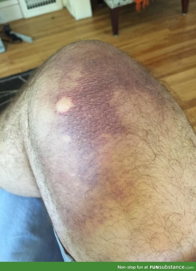 A mosquito sucked the blood out of a bruise