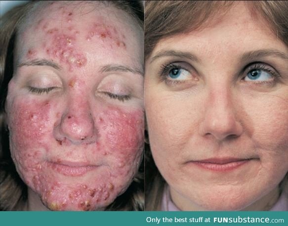 What 4 months of Isotretinoin medication for acne can do