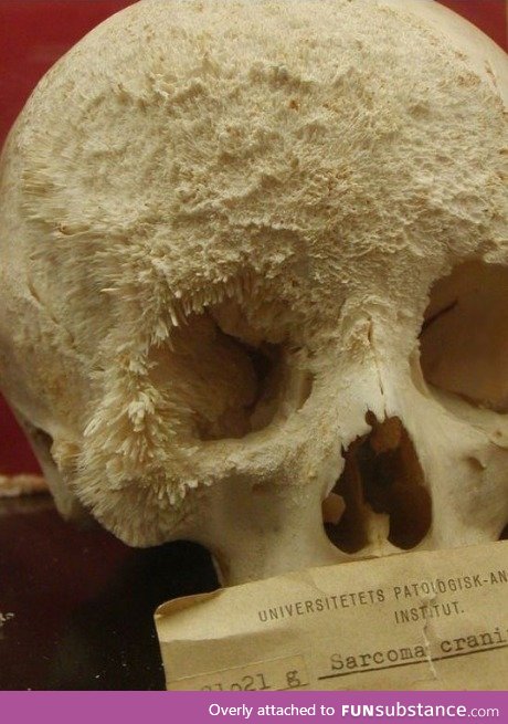 Bone Cancer patient's bone