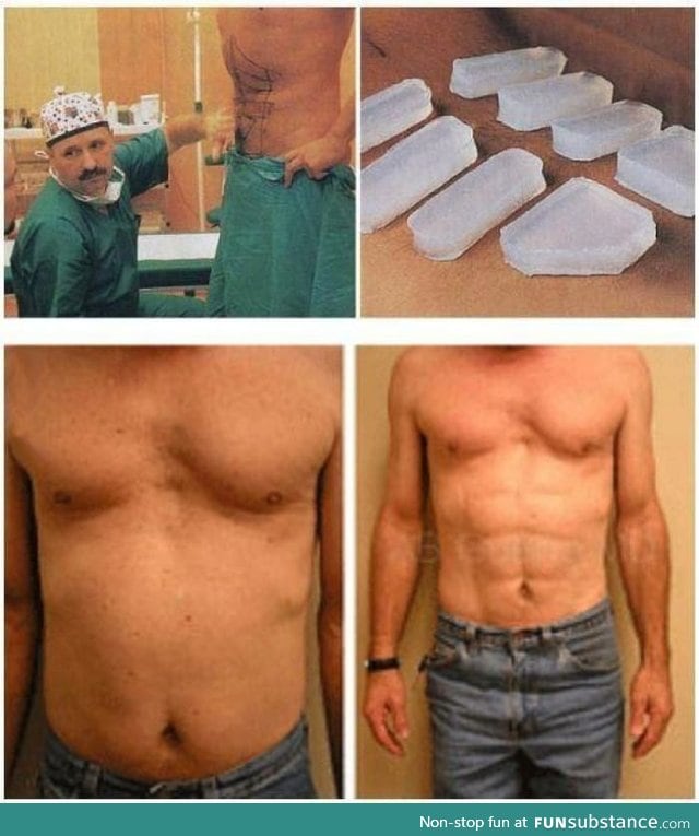 6-pack implants
