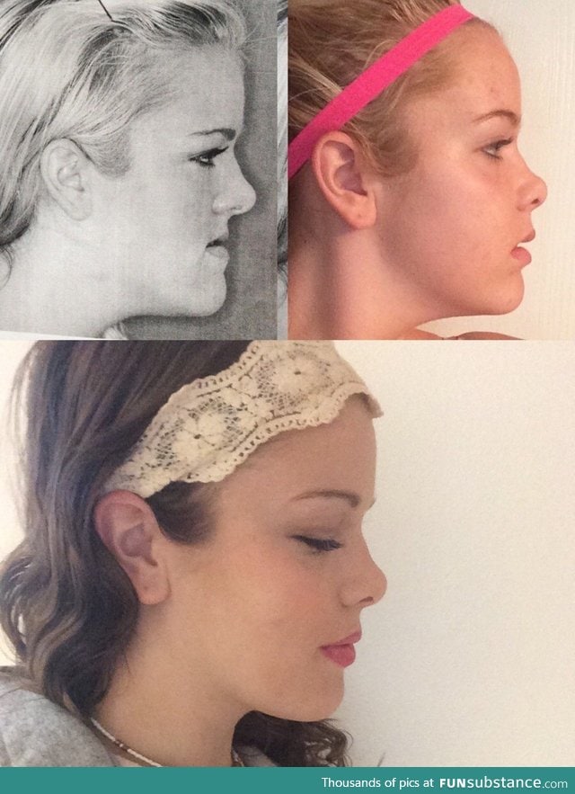 "One year ago today, I shared the top photo as results from a jaw surgery."