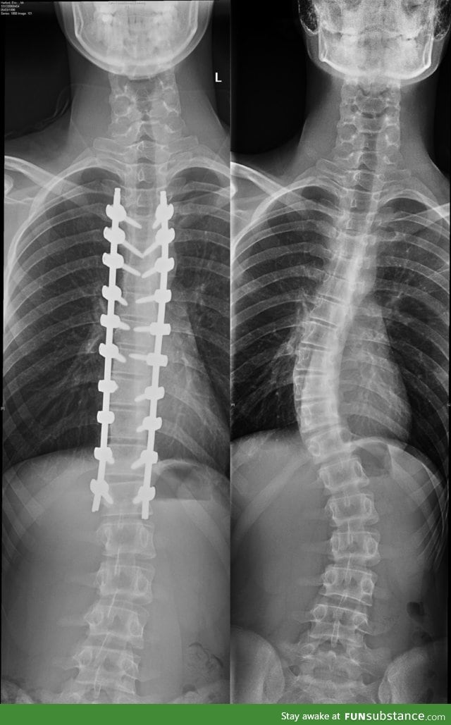Scoliosis surgery before and after x-rays