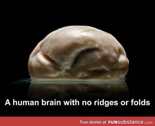 A human brain with no ridges