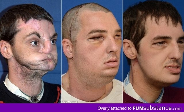Most Extensive Face Transplant In History