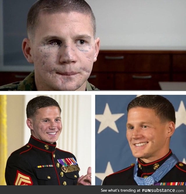 Medal Of Honor recipient Kyle Carpenter before and after facial reconstruction surgery
