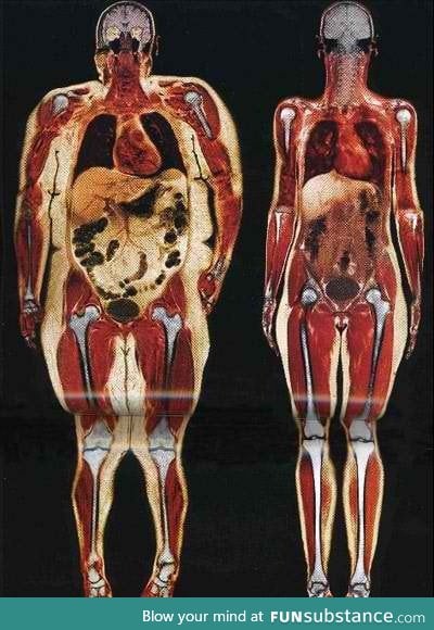 Body scans of women at 250 and 120 pounds