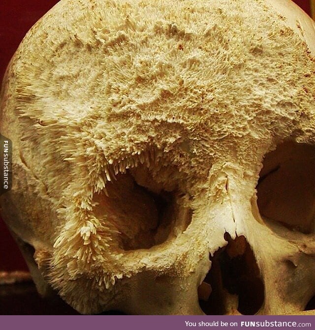 Bone cancer