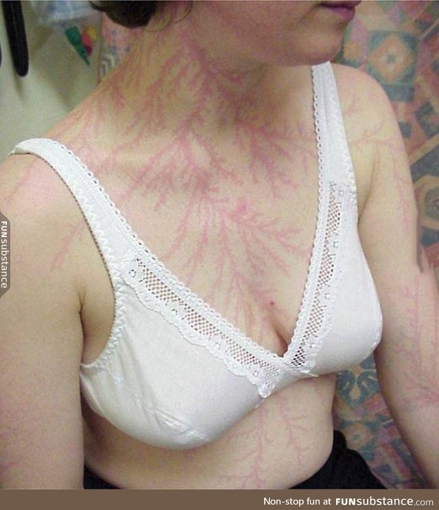 Woman with Lichtenberg figures, lightning-shaped scars from being hit by lightning