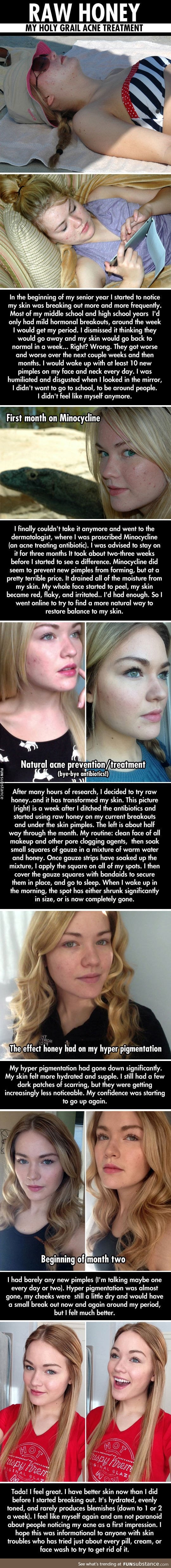 Holy grail acne treatment