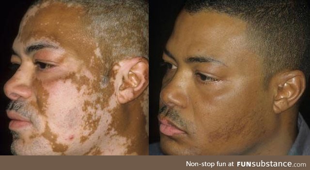 Tattooing to cover up vitiligo