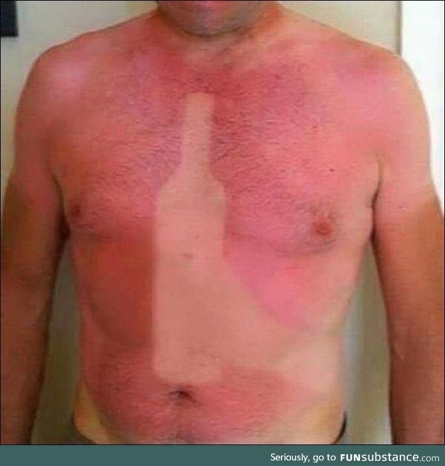 Came back from the beach with a bit of a sunburn