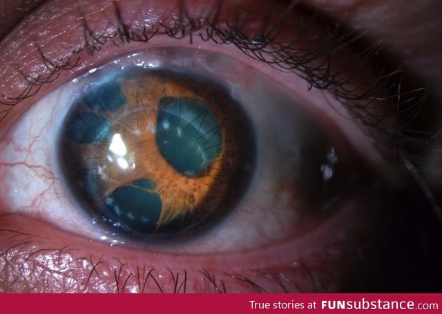 Eye infected with polycoria - Multiple pupils