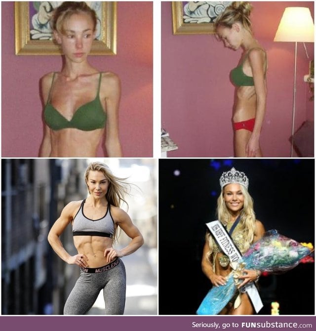 Formerly anorexic teenager to beauty champion- Hattie Boydle