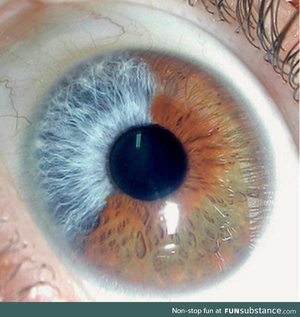Partial heterochromia of Iris