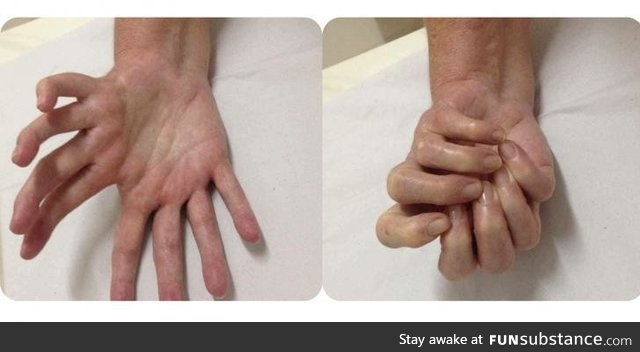 A rare Laurin Sandrow syndrome causes mirroring of hands