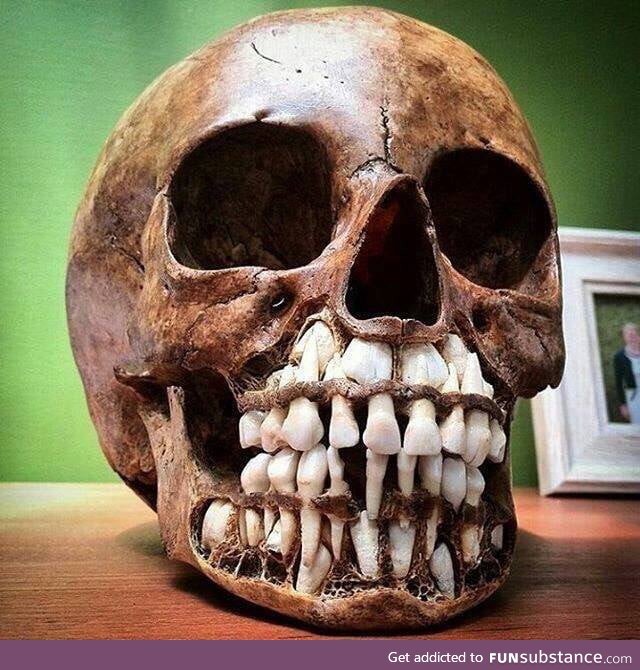 A Child's Skull, It Shows Their Baby Teeth With The Adult Teeth Above It